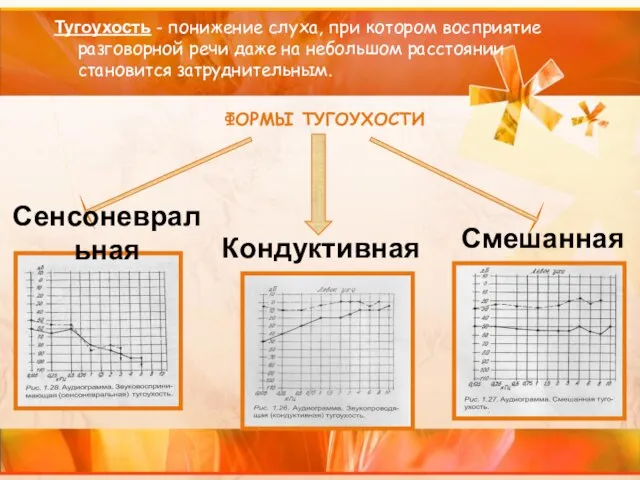 Тугоухость - понижение слуха, при котором восприятие разговорной речи даже на небольшом