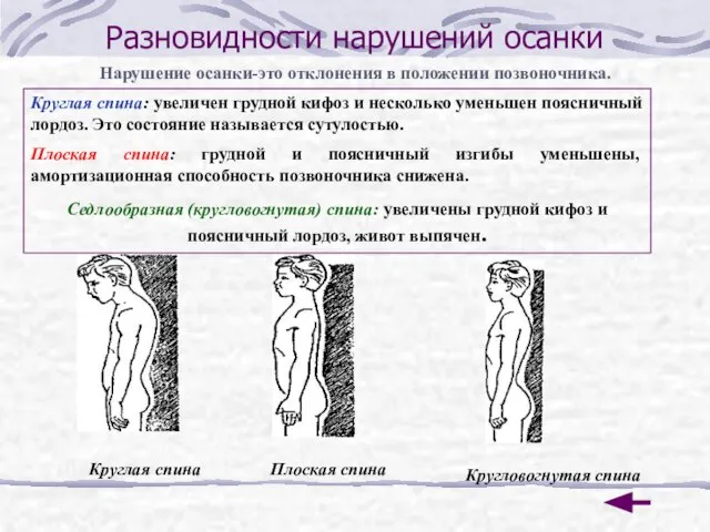 Разновидности нарушений осанки Нарушение осанки-это отклонения в положении позвоночника. Круглая спина: увеличен