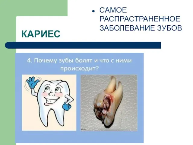 КАРИЕС САМОЕ РАСПРАСТРАНЕННОЕ ЗАБОЛЕВАНИЕ ЗУБОВ