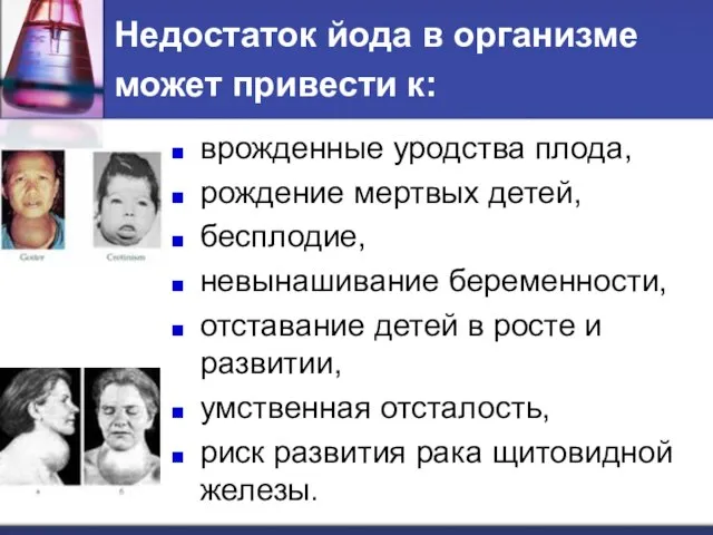 Недостаток йода в организме может привести к: врожденные уродства плода, рождение мертвых