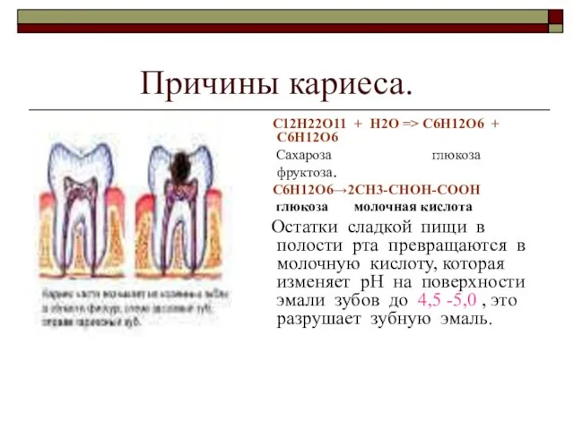 Причины кариеса. С12Н22О11 + Н2О => C6H12O6 + C6H12O6 Сахароза глюкоза фруктоза.