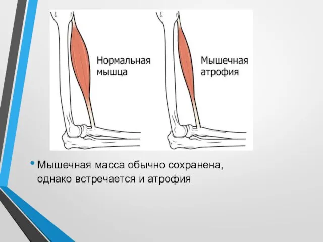 Мышечная масса обычно сохранена, однако встречается и атрофия