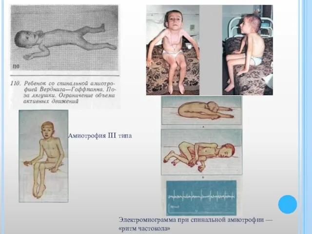 Электромиограмма при спинальной амиотрофии — «ритм частокола» Амиотрофия III типа
