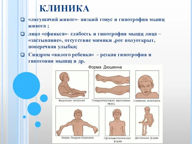 КЛИНИКА «лягушачий живот»- низкий тонус и гипотрофия мышц живота ; лицо «сфинкса»-