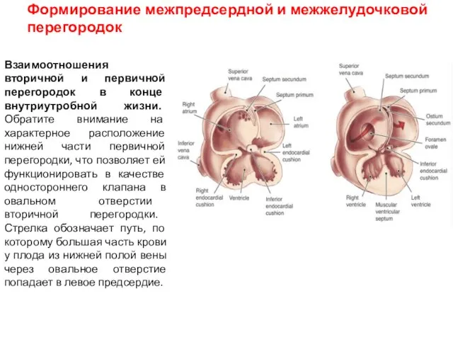 Формирование межпредсердной и межжелудочковой перегородок Взаимоотношения вторичной и первичной перегородок в конце