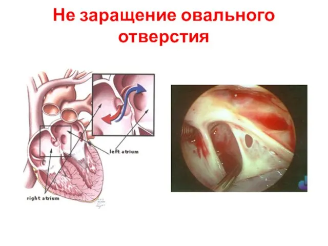 Не заращение овального отверстия