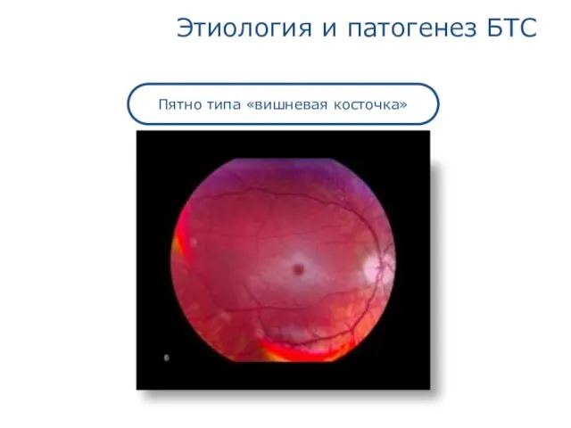 Этиология и патогенез БТС Пятно типа «вишневая косточка»