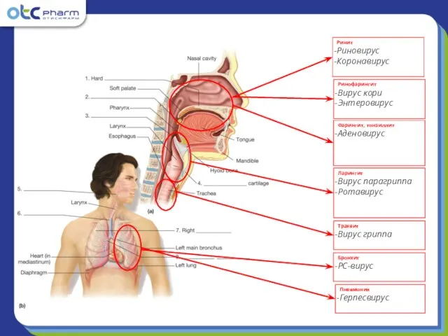 Ринит Риновирус Коронавирус Ринофарингит Вирус кори Энтеровирус Фарингит, тонзиллит Аденовирус Ларингит Вирус