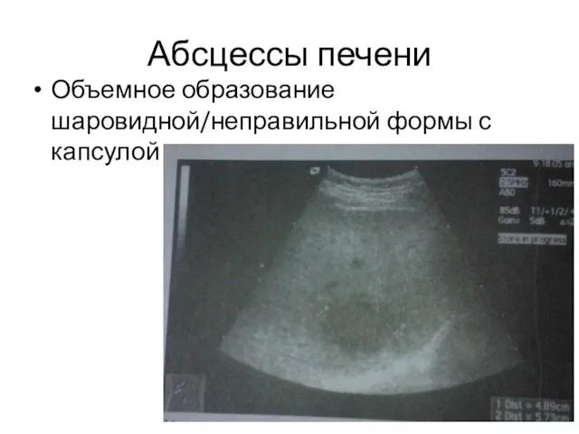 Абсцессы печени Объемное образование шаровидной/неправильной формы с капсулой