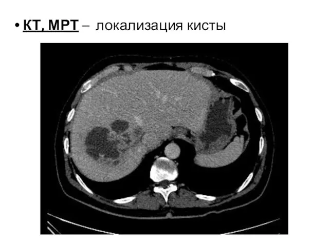 КТ, МРТ – локализация кисты