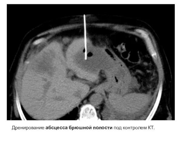 Дренирование абсцесса брюшной полости под контролем КТ.