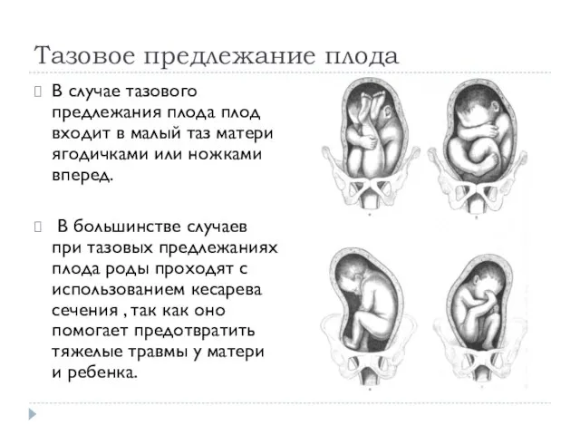 Тазовое предлежание плода В случае тазового предлежания плода плод входит в малый