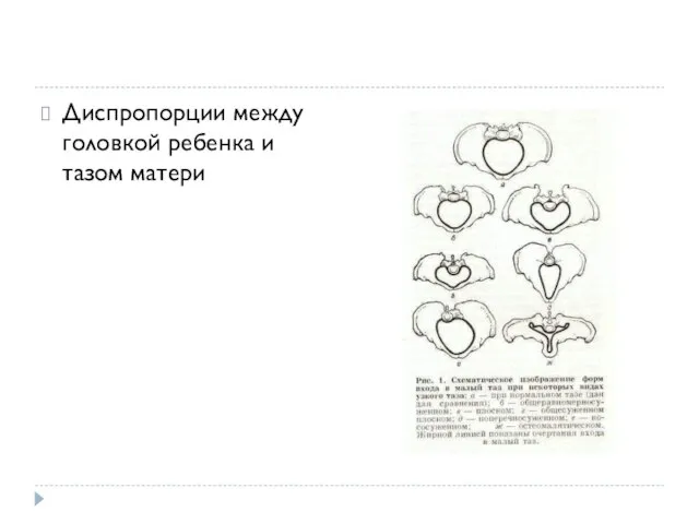 Диспропорции между головкой ребенка и тазом матери