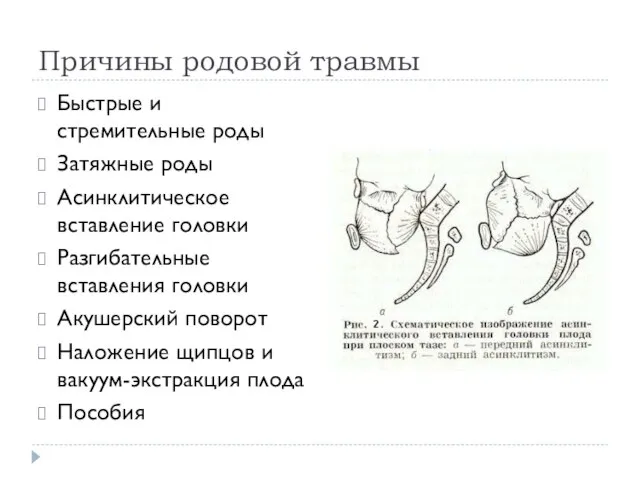 Причины родовой травмы Быстрые и стремительные роды Затяжные роды Асинклитическое вставление головки