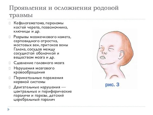 Проявления и осложнения родовой травмы Кефалогематома, переломы костей черепа, позвоночника, ключицы и