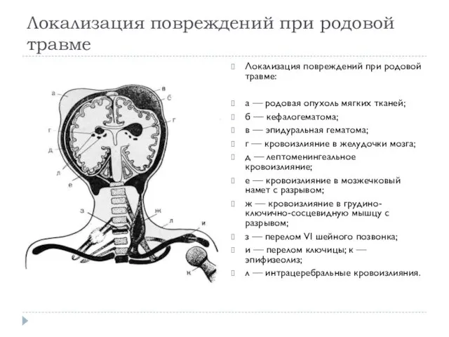 Локализация повреждений при родовой травме Локализация повреждений при родовой травме: а —