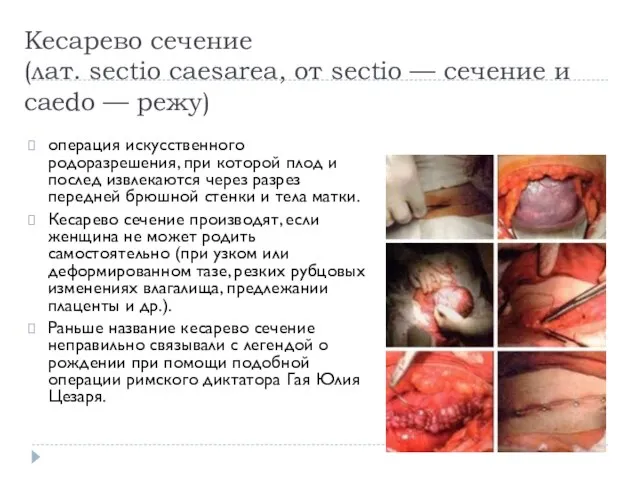 Кесарево сечение (лат. sectio caesarea, от sectio — сечение и caedo —