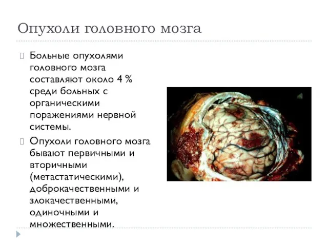 Опухоли головного мозга Больные опухолями головного мозга составляют около 4 % среди