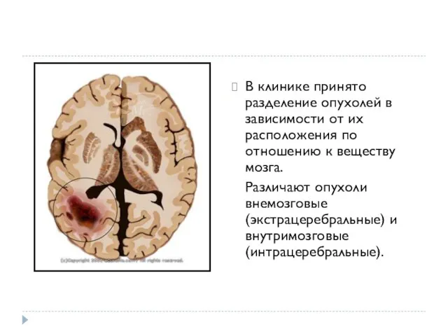 В клинике принято разделение опухолей в зависимости от их расположения по отношению