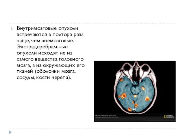 Внутримозговые опухоли встречаются в полтора раза чаще, чем внемозговые. Экстрацеребральные опухоли исходят