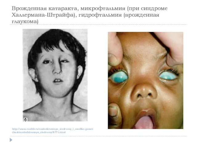 Врожденная катаракта, микрофтальмия (при синдроме Халлермана-Штрайфа), гидрофтальмия (врожденная глаукома) http://www.meddr.ru/nasledstvennye_sindromy_i_mediko-genetichesk/nasledstvennye_sindromy/8771.html