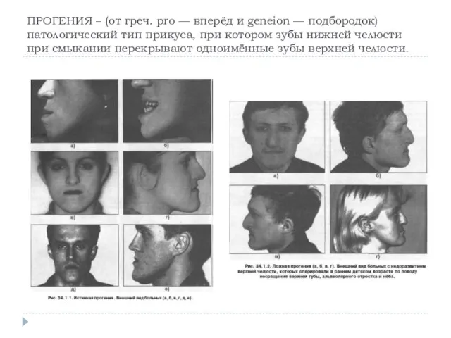 ПРОГЕНИЯ – (от греч. pro — вперёд и geneion — подбородок) патологический