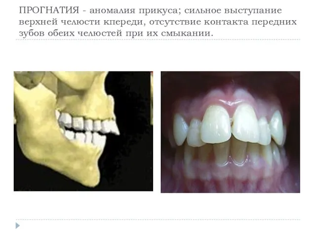 ПРОГНАТИЯ - аномалия прикуса; сильное выступание верхней челюсти кпереди, отсутствие контакта передних