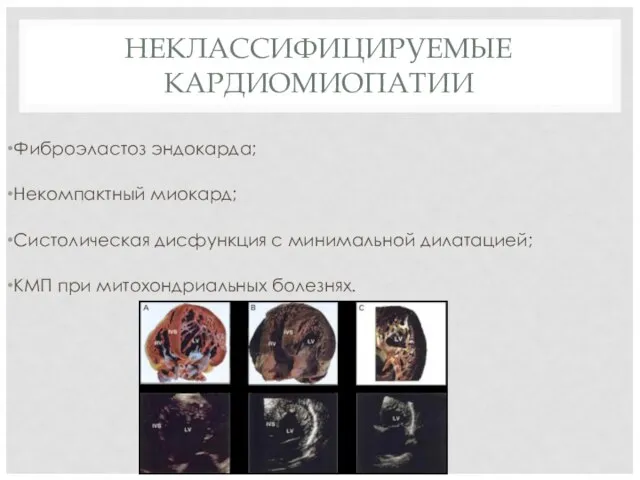 НЕКЛАССИФИЦИРУЕМЫЕ КАРДИОМИОПАТИИ Фиброэластоз эндокарда; Некомпактный миокард; Систолическая дисфункция с минимальной дилатацией; КМП при митохондриальных болезнях.