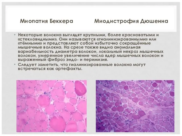 Миопатия Беккера Некоторые волокна выглядят крупными, более красноватыми и «стекловидными». Они называются