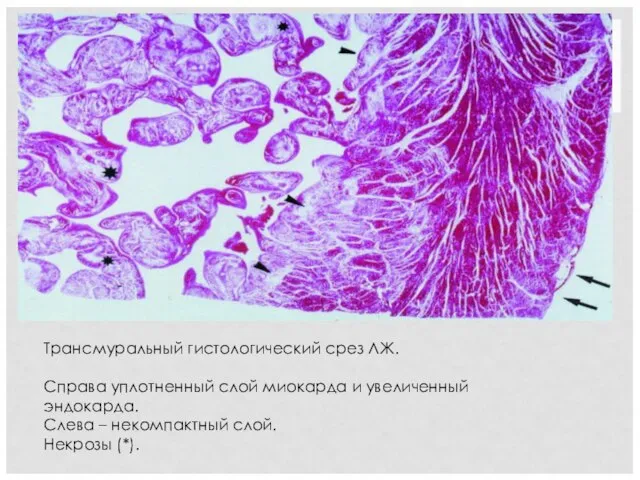 Трансмуральный гистологический срез ЛЖ. Справа уплотненный слой миокарда и увеличенный эндокарда. Слева