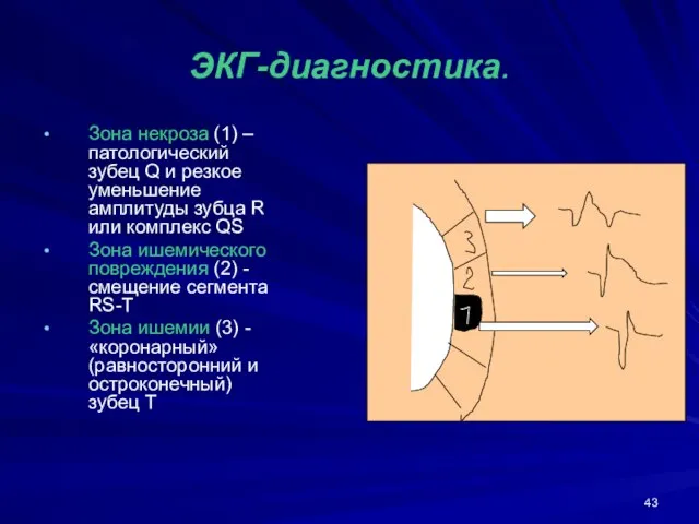 ЭКГ-диагностика. Зона некроза (1) –патологический зубец Q и резкое уменьшение амплитуды зубца