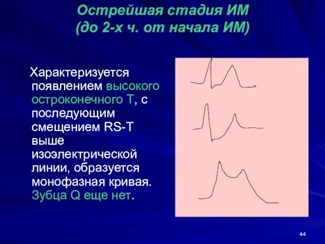 Острейшая стадия ИМ (до 2-х ч. от начала ИМ) Характеризуется появлением высокого