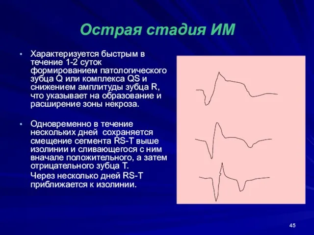 Острая стадия ИМ Характеризуется быстрым в течение 1-2 суток формированием патологического зубца