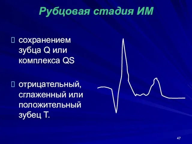 Рубцовая стадия ИМ сохранением зубца Q или комплекса QS отрицательный, сглаженный или положительный зубец Т.