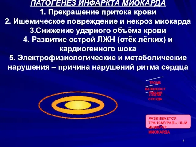 ПАТОГЕНЕЗ ИНФАРКТА МИОКАРДА 1. Прекращение притока крови 2. Ишемическое повреждение и некроз