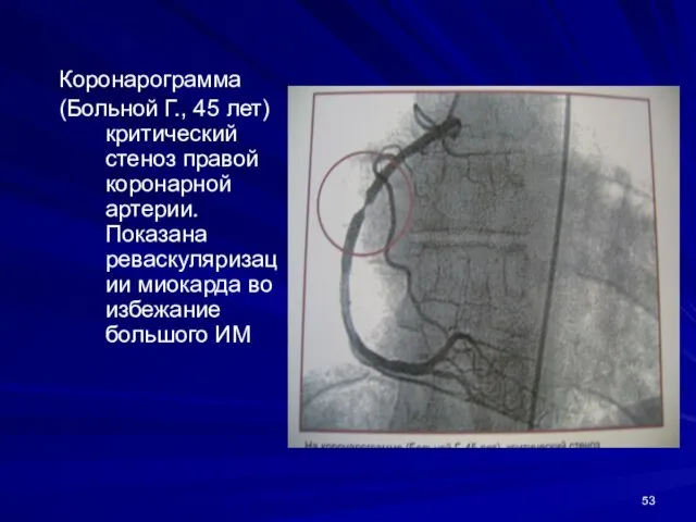 Коронарограмма (Больной Г., 45 лет) критический стеноз правой коронарной артерии. Показана реваскуляризации