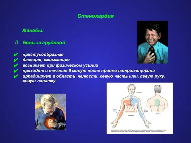Стенокардия Жалобы: Боль за грудиной приступообразная давящая, сжимающая возникает при физическом усилии