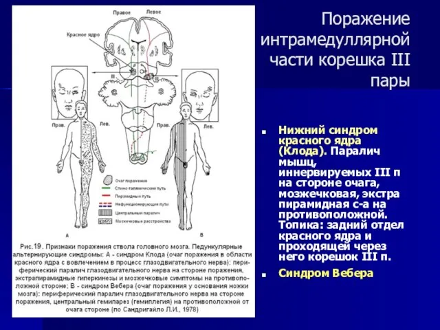 Поражение интрамедуллярной части корешка III пары Нижний синдром красного ядра (Клода). Паралич