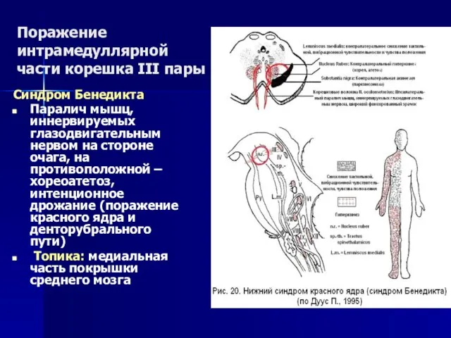 Поражение интрамедуллярной части корешка III пары Синдром Бенедикта Паралич мышц, иннервируемых глазодвигательным