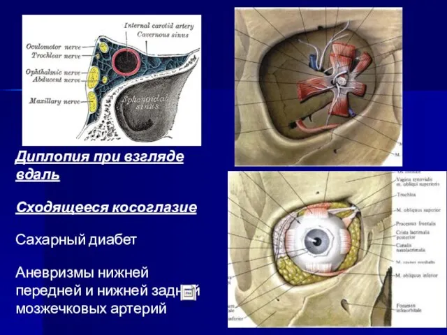 Диплопия при взгляде вдаль Сходящееся косоглазие Сахарный диабет Аневризмы нижней передней и нижней задней мозжечковых артерий