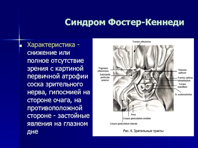 Синдром Фостер-Кеннеди Характеристика - снижение или полное отсутствие зрения с картиной первичной