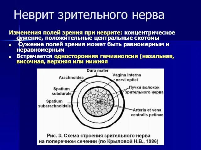 Неврит зрительного нерва Изменения полей зрения при неврите: концентрическое сужение, положительные центральные