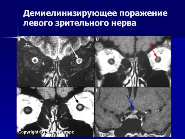 Демиелинизирующее поражение левого зрительного нерва