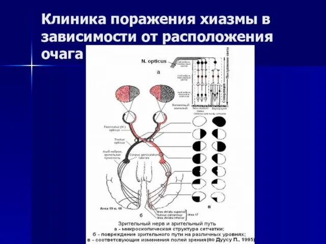 Клиника поражения хиазмы в зависимости от расположения очага