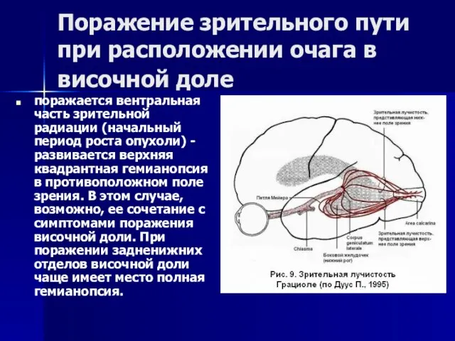 Поражение зрительного пути при расположении очага в височной доле поражается вентральная часть