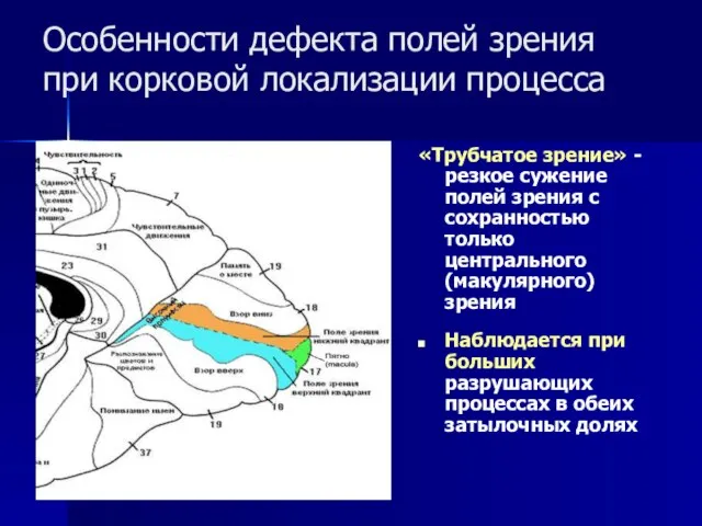 Особенности дефекта полей зрения при корковой локализации процесса «Трубчатое зрение» - резкое