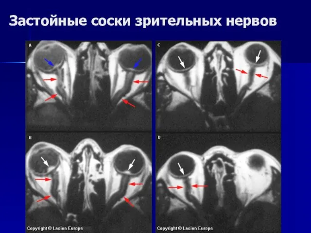 Застойные соски зрительных нервов