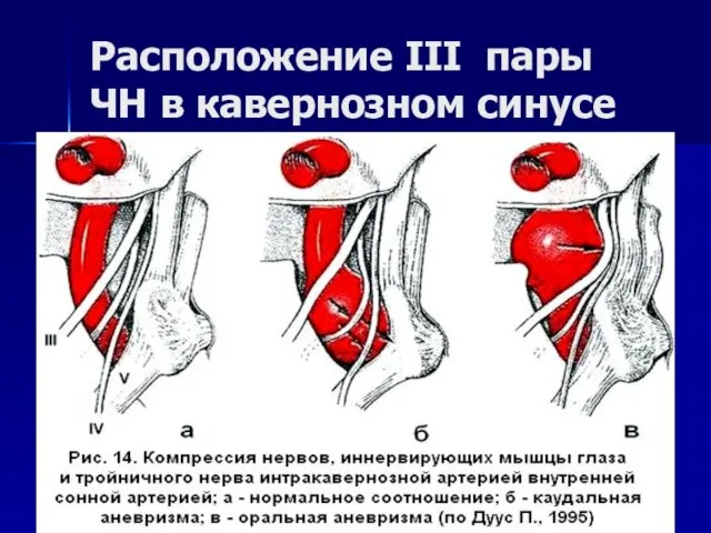 Расположение III пары ЧН в кавернозном синусе