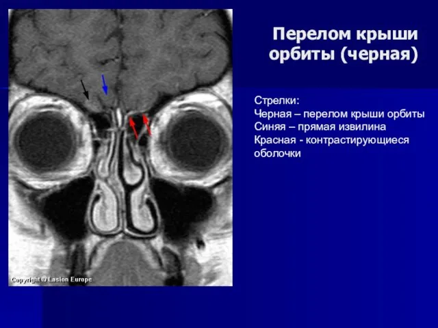 Перелом крыши орбиты (черная) Стрелки: Черная – перелом крыши орбиты Синяя –