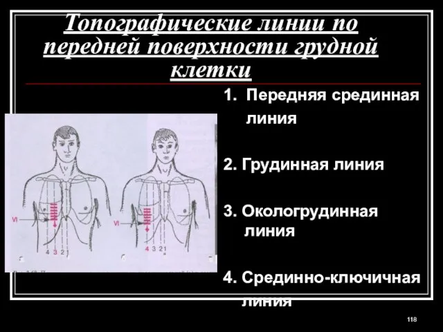 Топографические линии по передней поверхности грудной клетки 1. Передняя срединная линия 2.